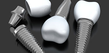 Dental Implants